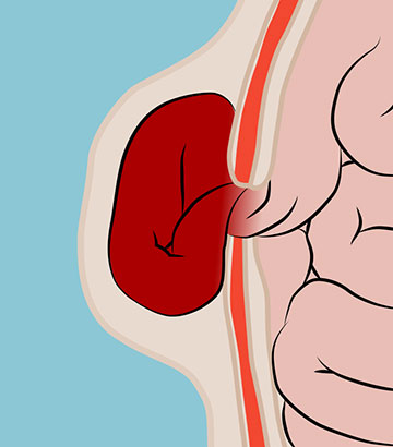 Intestinal Obstruction due to Bilateral Strangulated Femoral Hernias